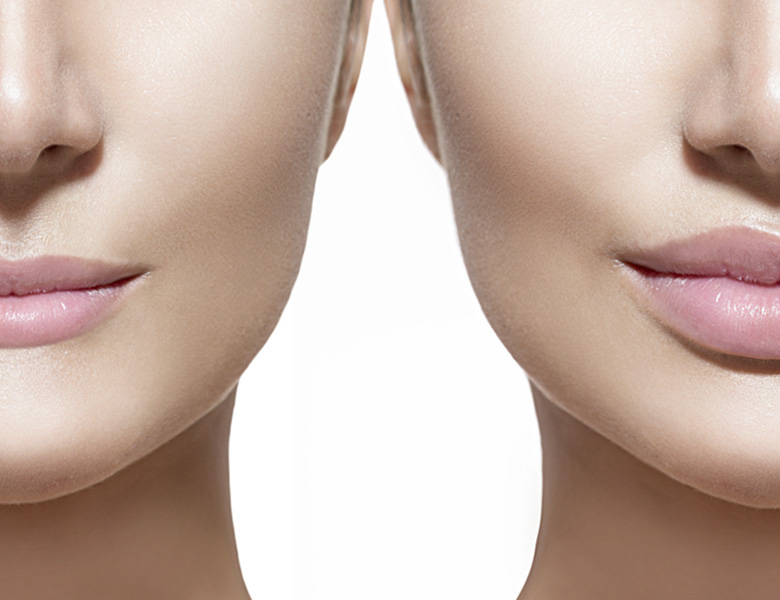 lip augment