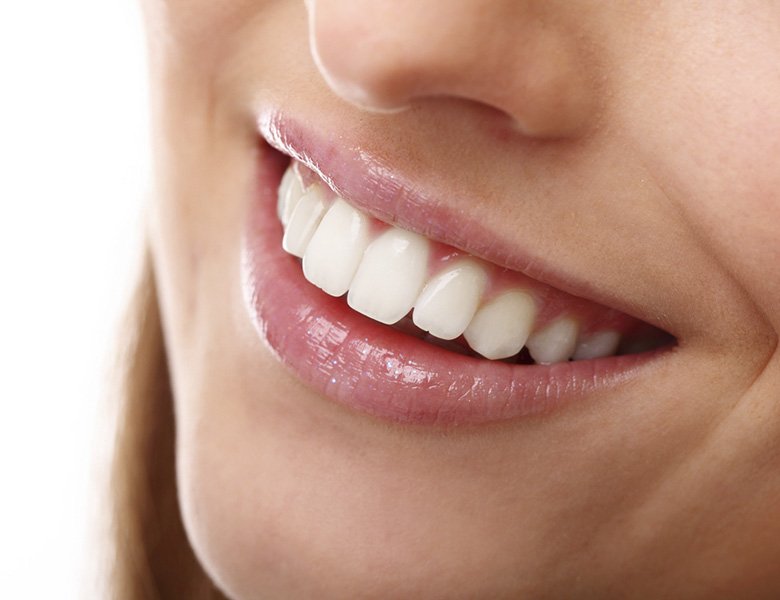 veneer